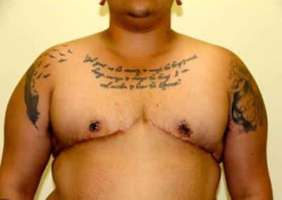 After Image: Breast Reduction for Men - front