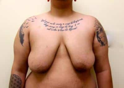Before Image: Breast Reduction for Men - front
