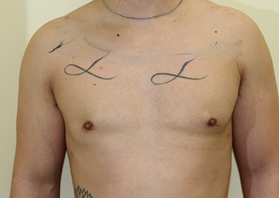 After Image: Breast Reduction for Men - front
