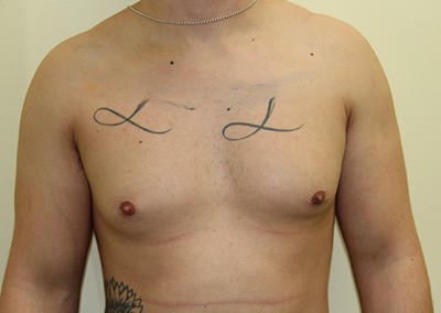 Before Image: Breast Reduction for Men - front