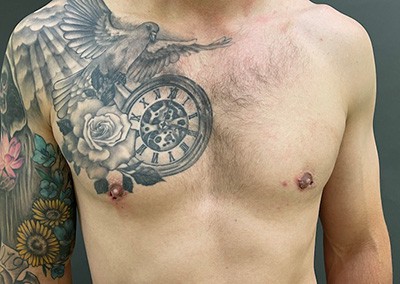 After Image: Breast Reduction for Men - front