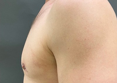 After Image: Breast Reduction for Men - left-side