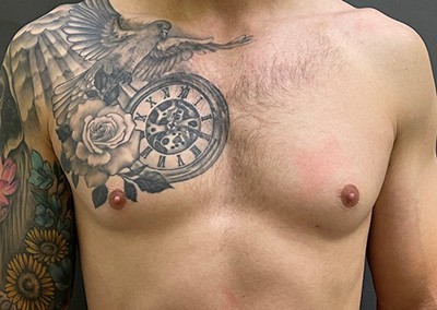 Before Image: Breast Reduction for Men - front