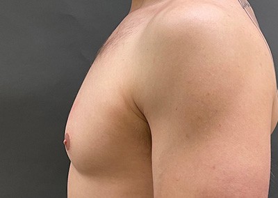 Before Image: Breast Reduction for Men - left-side