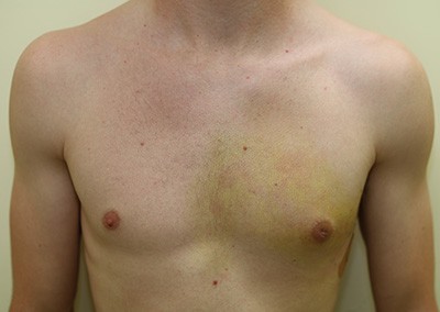After Image: Breast Reduction for Men - front