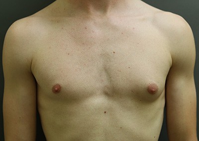 Before Image: Breast Reduction for Men - front