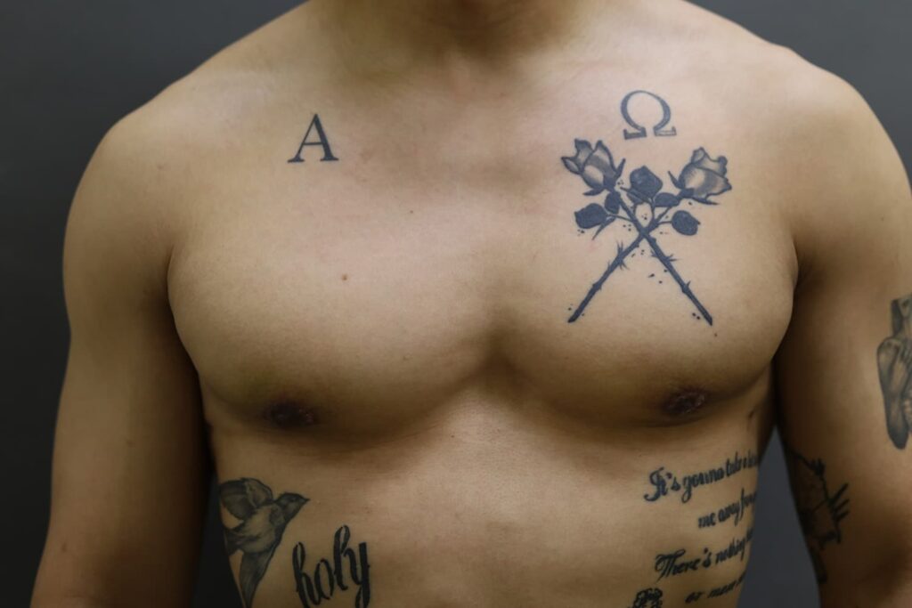 After Image: Breast Reduction for Men - front