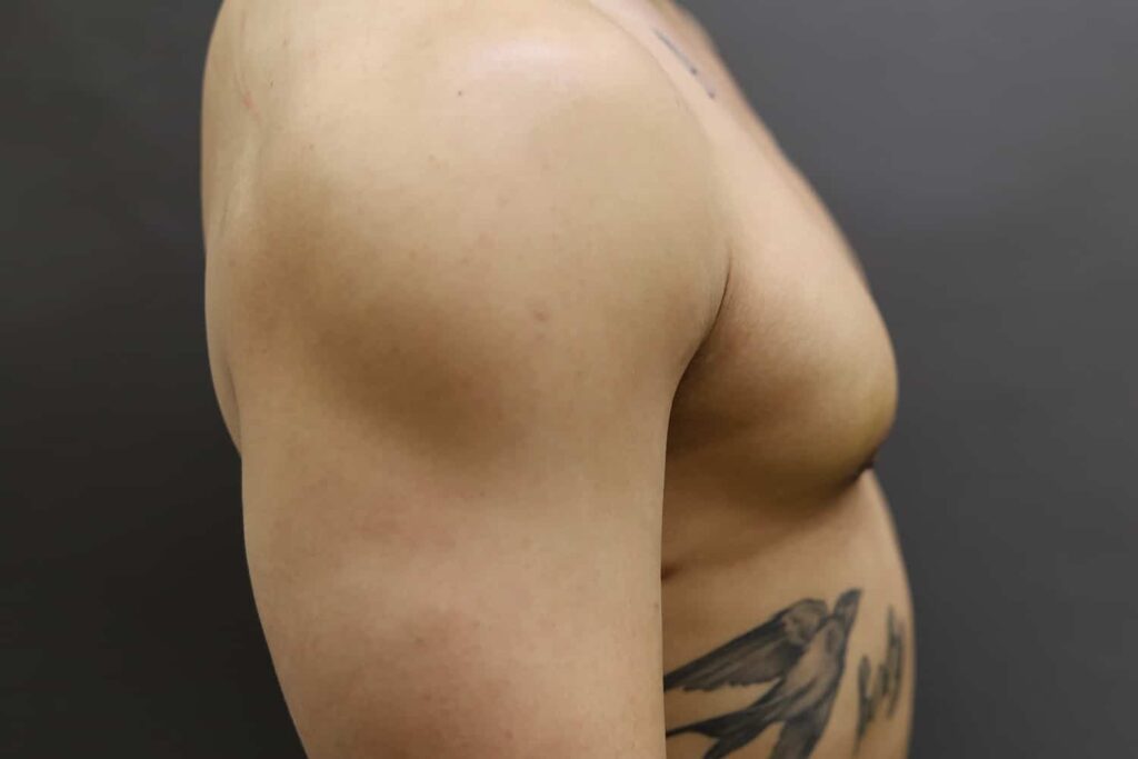 After Image: Breast Reduction for Men - right-side