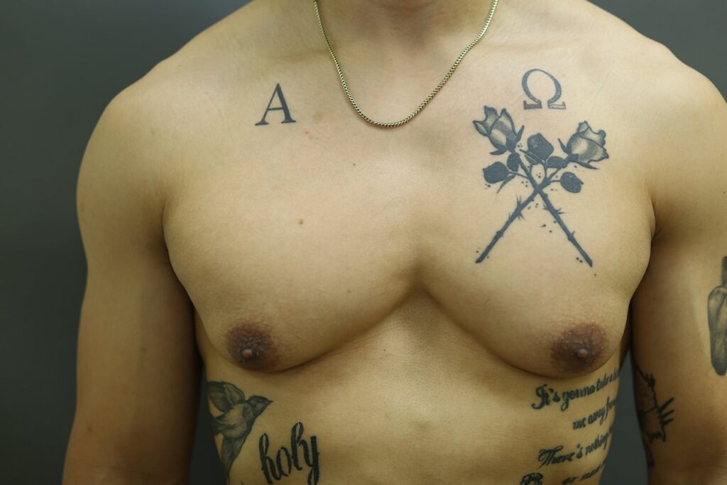 Before Image: Breast Reduction for Men - front