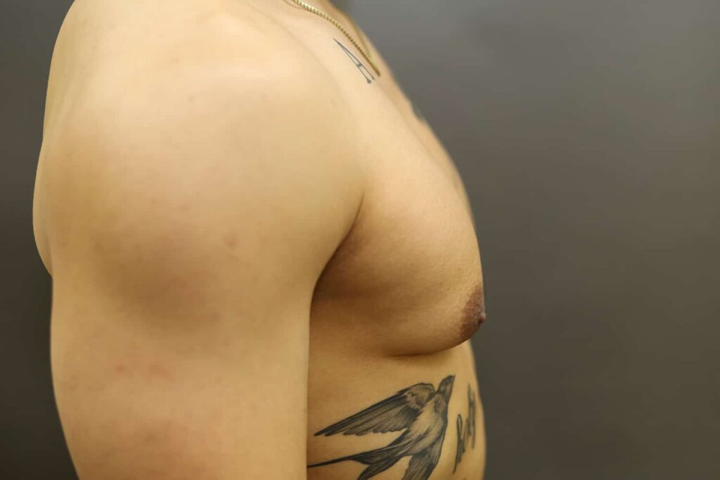 Before Image: Breast Reduction for Men - right-side