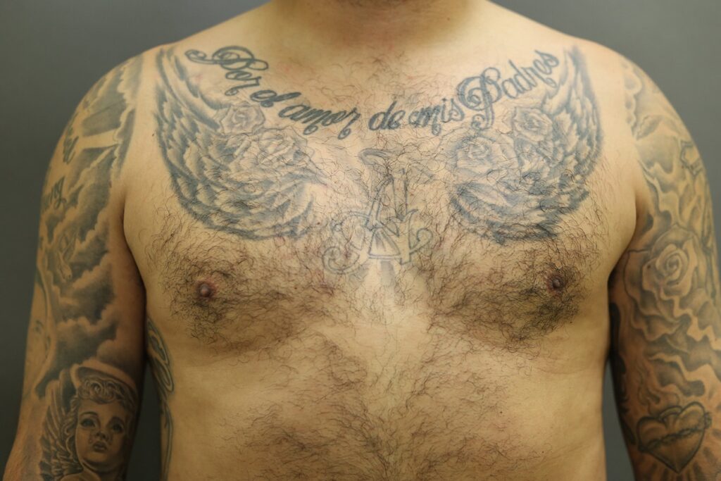 After Image: Breast Reduction for Men - front