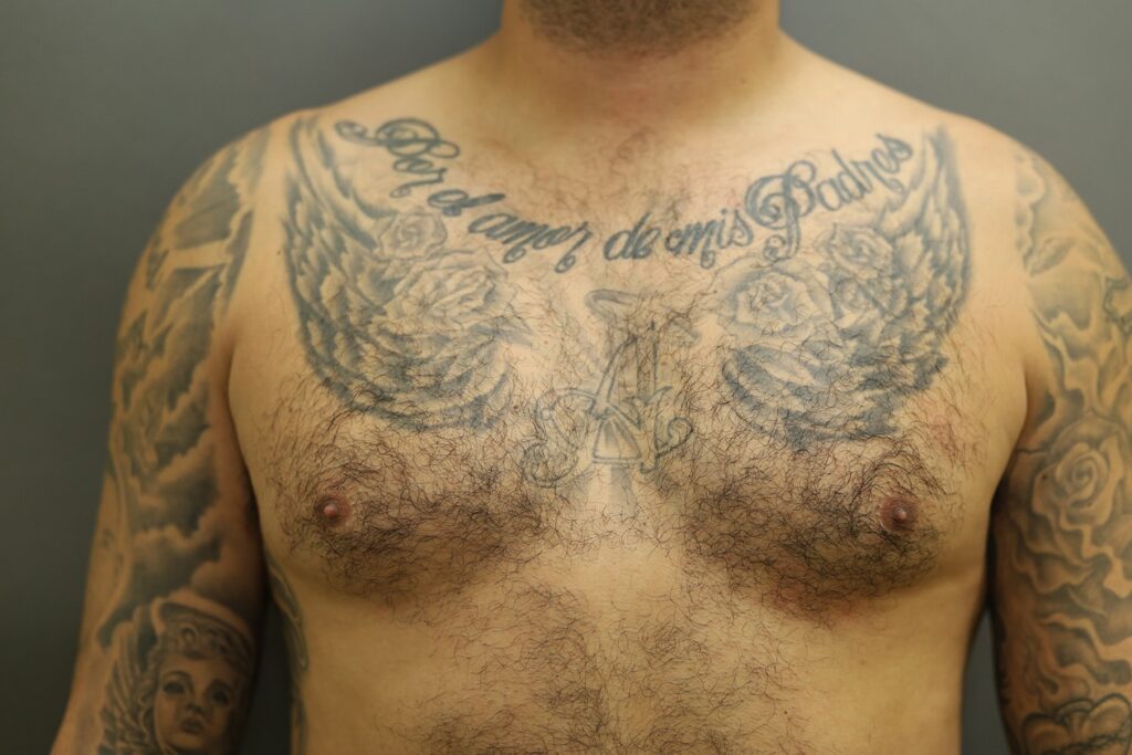 Before Image: Breast Reduction for Men - front