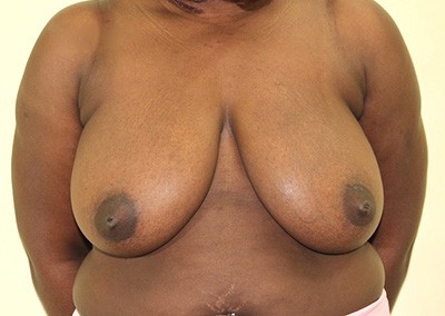 Before Image: Breast Reduction - front