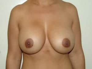 After Image: Capsular Contracture - front