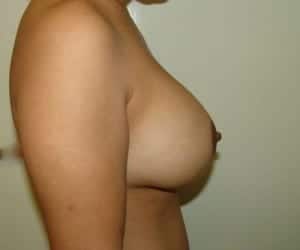 Before Image: Capsular Contracture - right-side