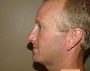 After Image: Chin Surgery - front