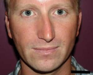 Before Image: Chin Surgery - front