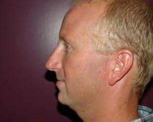 Before Image: Chin Surgery - front