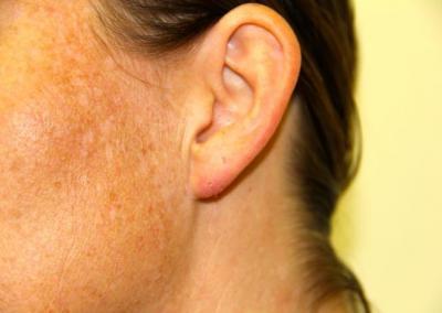 After Image: Ear Lobe Repair - left-side