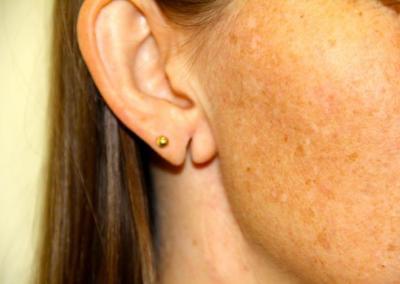 Before Image: Ear Lobe Repair - right-front-oblique