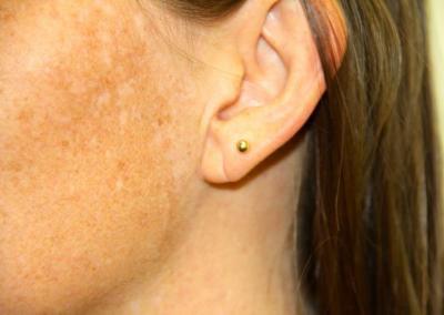 Before Image: Ear Lobe Repair - left-side