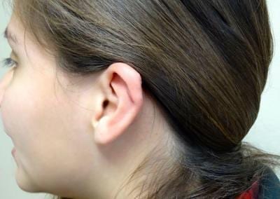 After Image: Ear Surgery - left-back-oblique