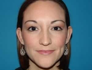 Before Image: Ear Surgery - front