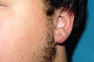 After Image: Ear Surgery - front