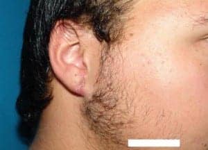 After Image: Ear Surgery - right-side