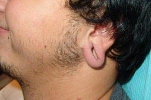 Before Image: Ear Surgery - front