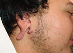 Before Image: Ear Surgery - right-side