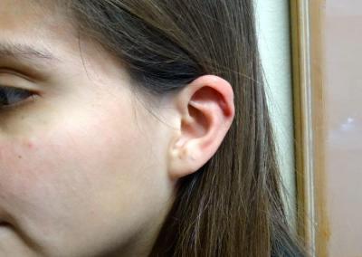 After Image: Ear Surgery - left-front-oblique