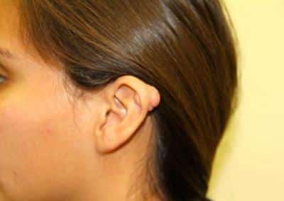 Before Image: Ear Surgery - left-front-oblique