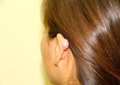 Before Image: Ear Surgery - left-back-oblique