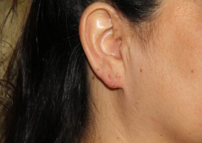 After Image: Ear Surgery - right-side