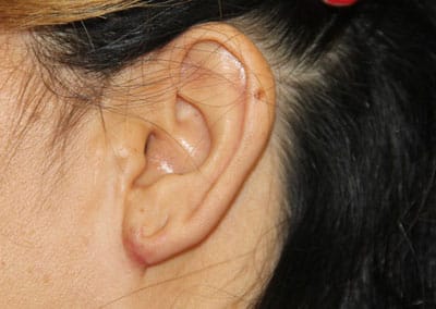 After Image: Ear Surgery - left-side