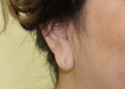 Before Image: Ear Surgery - right-side