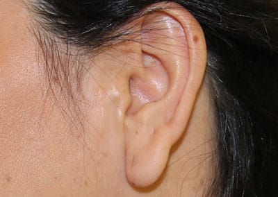 Before Image: Ear Surgery - left-side