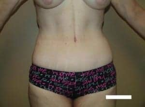 After Image: Extended Tummy Tuck - front