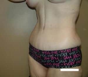 After Image: Extended Tummy Tuck - left-front-oblique