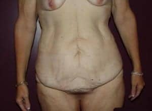 Before Image: Extended Tummy Tuck - front