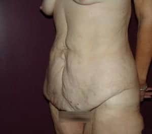 Before Image: Extended Tummy Tuck - left-front-oblique