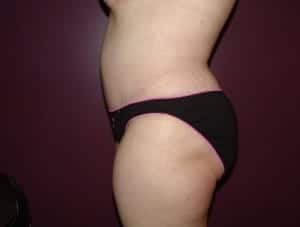 After Image: Extended Tummy Tuck - left-side