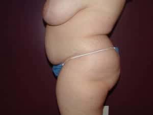 Before Image: Extended Tummy Tuck - left-side