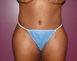 After Image: Extended Tummy Tuck - front
