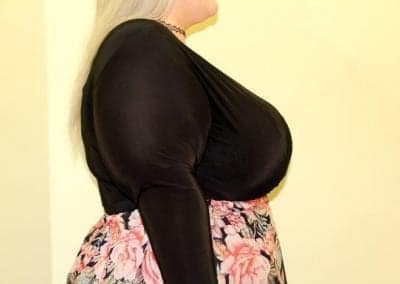 After Image: Extra Large Breast Implants - front