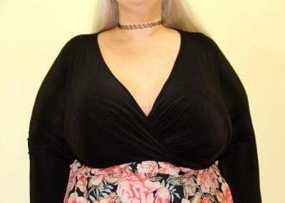 Before Image: Extra Large Breast Implants - front