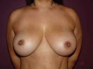 After Image: Extra Large Breast Implants - front