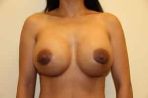 After Image: Extra Large Breast Implants - front