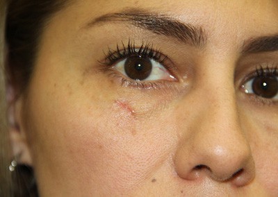 After Image: Face Reconstruction - front
